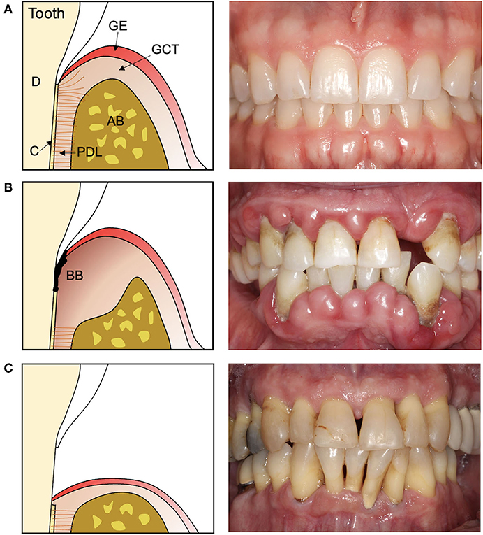 After 8 months from the regenerative surgery, the implant was placed