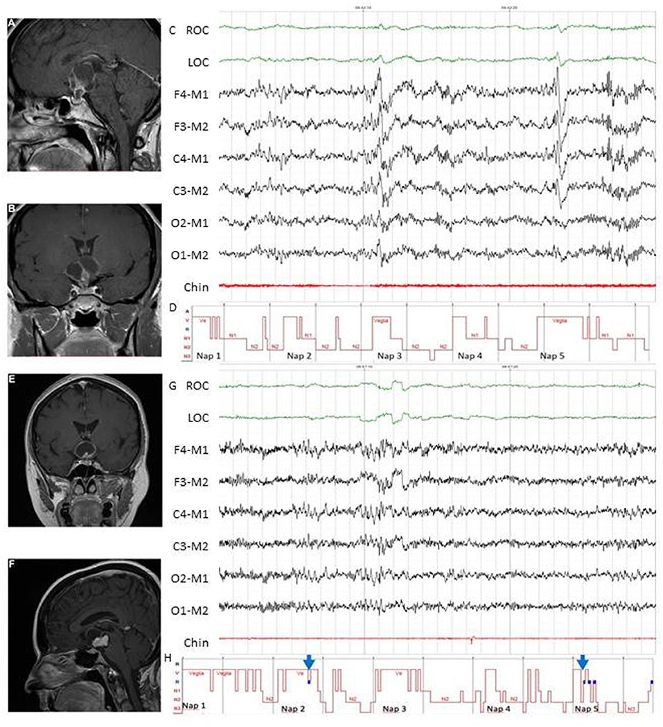 National UK guidelines for the management of paediatric craniopharyngioma -  The Lancet Diabetes & Endocrinology