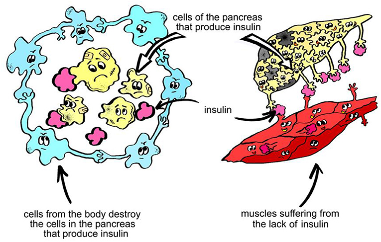 Figure 1 - In type 1 diabetes, the insulin-producing cells of the pancreas are damaged by the body’s own immune system.