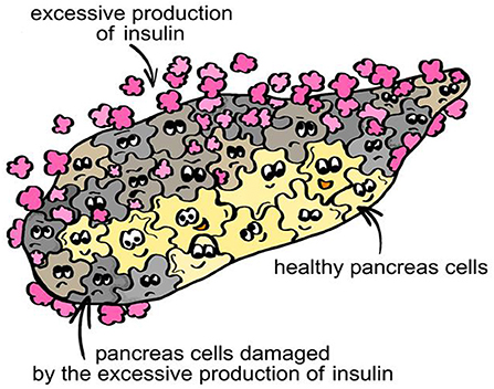 Figure 2 - In type 2 diabetes, the insulin-producing cells of the pancreas are destroyed by excessive production of insulin so, over time, less insulin is produced and diabetes results.