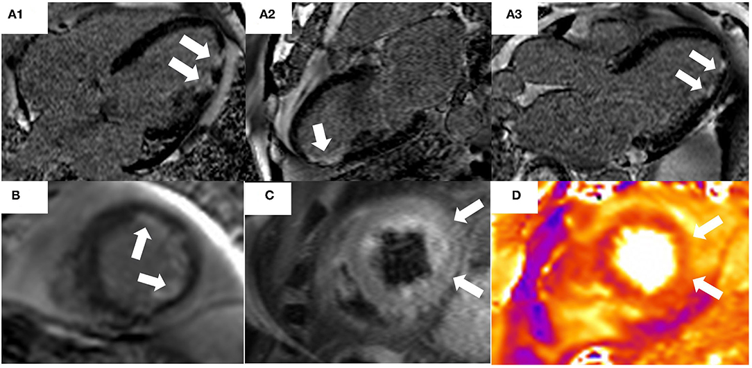 Echocardiography and cardiovascular magnetic resonance based evaluation of myocardial  strain and relationship with late gadolinium enhancement, Journal of  Cardiovascular Magnetic Resonance