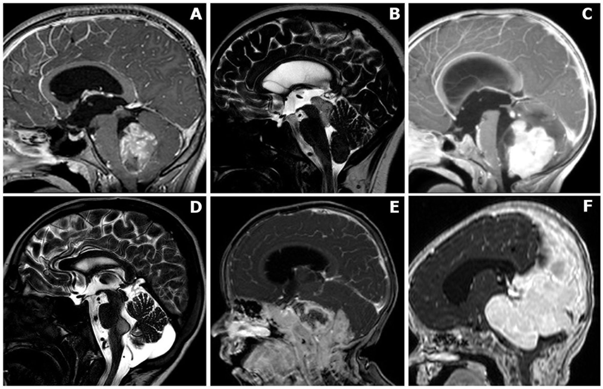 Outcomes and surgical approaches for pineal region tumors in children: 30  years' experience in: Journal of Neurosurgery: Pediatrics Volume 32 Issue 2  (2023) Journals