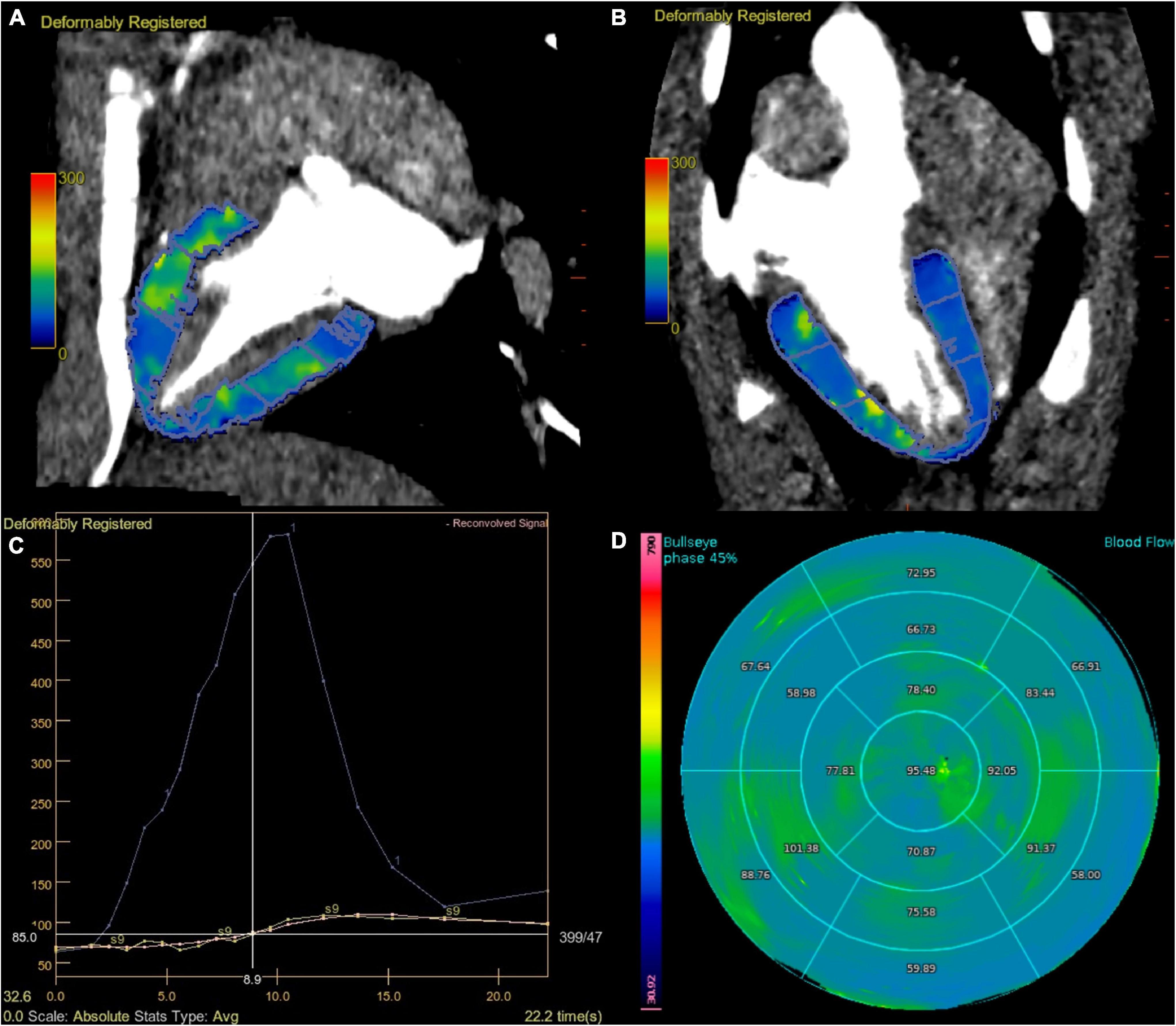 Left Ventricular Strain from Myocardial Perfusion PET Imaging
