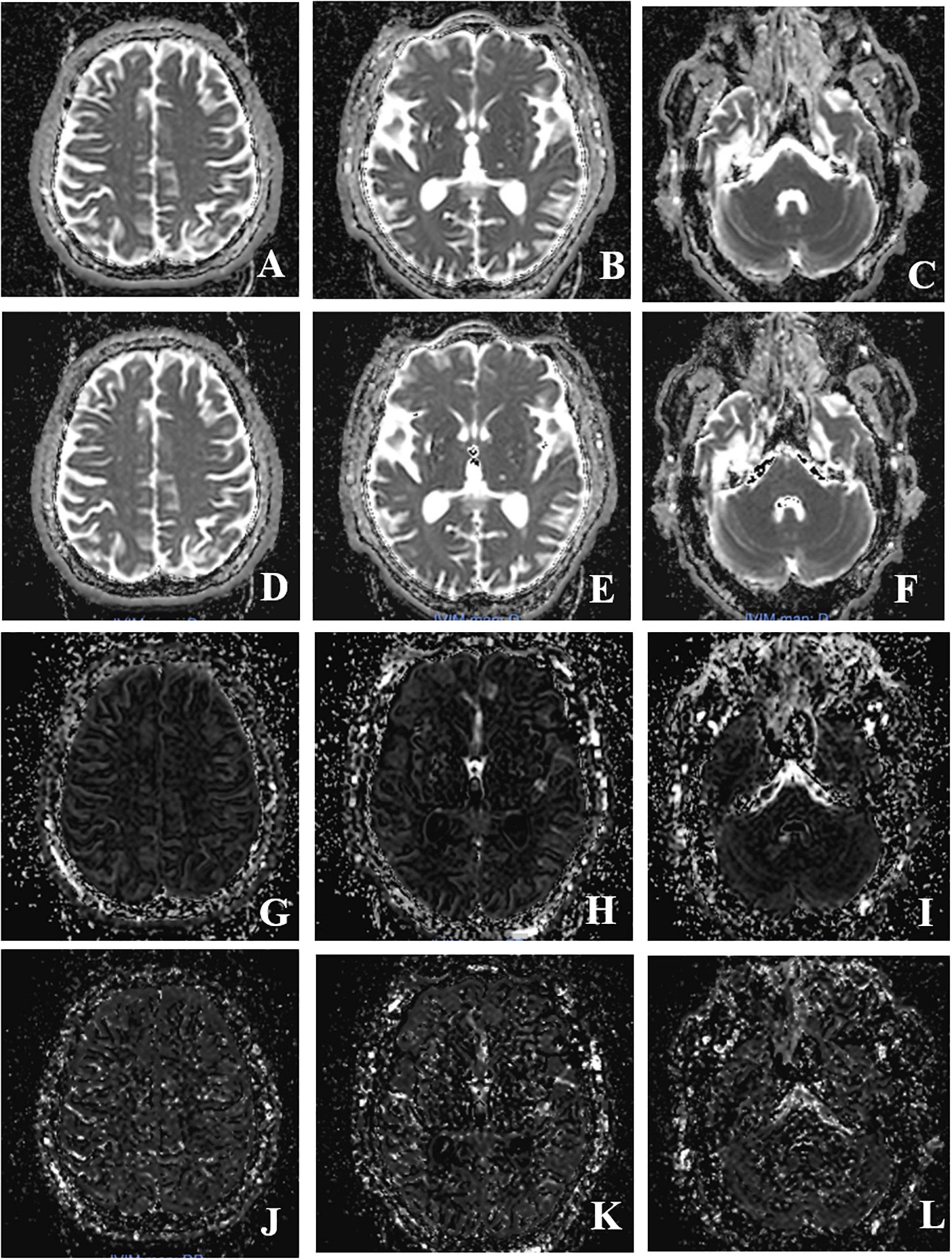 Frontiers | Intravoxel Incoherent Motion Magnetic Resonance Imaging Used in Preoperative Screening of High-Risk Patients With Moyamoya Disease Who May Develop Postoperative Cerebral Hyperperfusion Syndrome Frontiers | Intravoxel Incoherent Motion Magnetic Resonance Imaging Used in Preoperative Screening of High-Risk Patients With Moyamoya Disease Who May Develop Postoperative Cerebral Hyperperfusion Syndrome