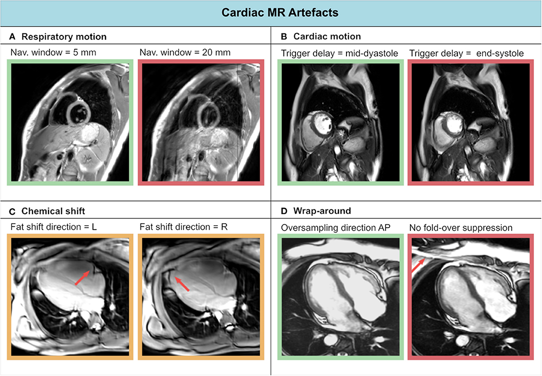 Myocardial Strain Evaluation with Cardiovascular MRI: Physics, Principles,  and Clinical Applications