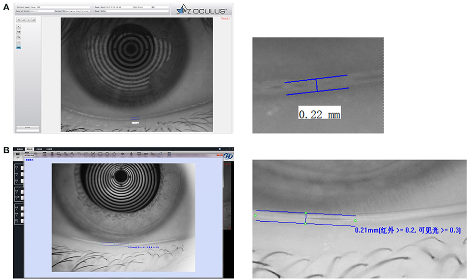 Dangers of Fake Eyelashes  Mitchell Refractive Surgery & Eye Center