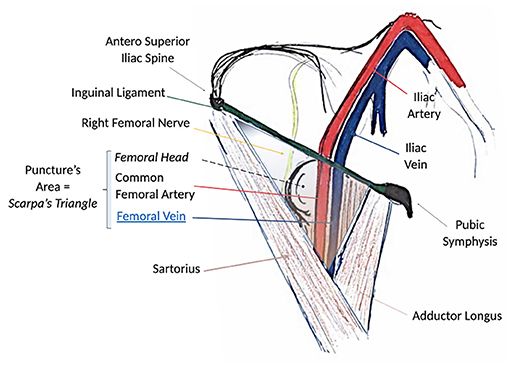 Frontiers  Percutaneous Venous Cannulation for Minimally Invasive Cardiac  Surgery: The Safest and Effective Technique Described Step-by-Step