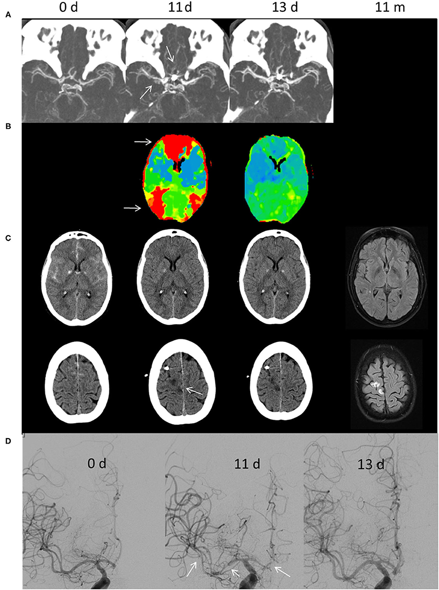 Frontiers  Delayed Cerebral Ischemia After Subarachnoid