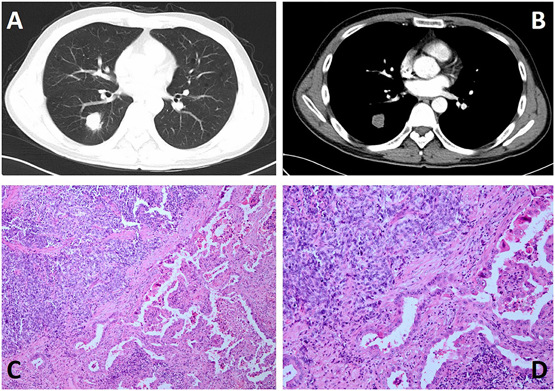 case study lung carcinoma