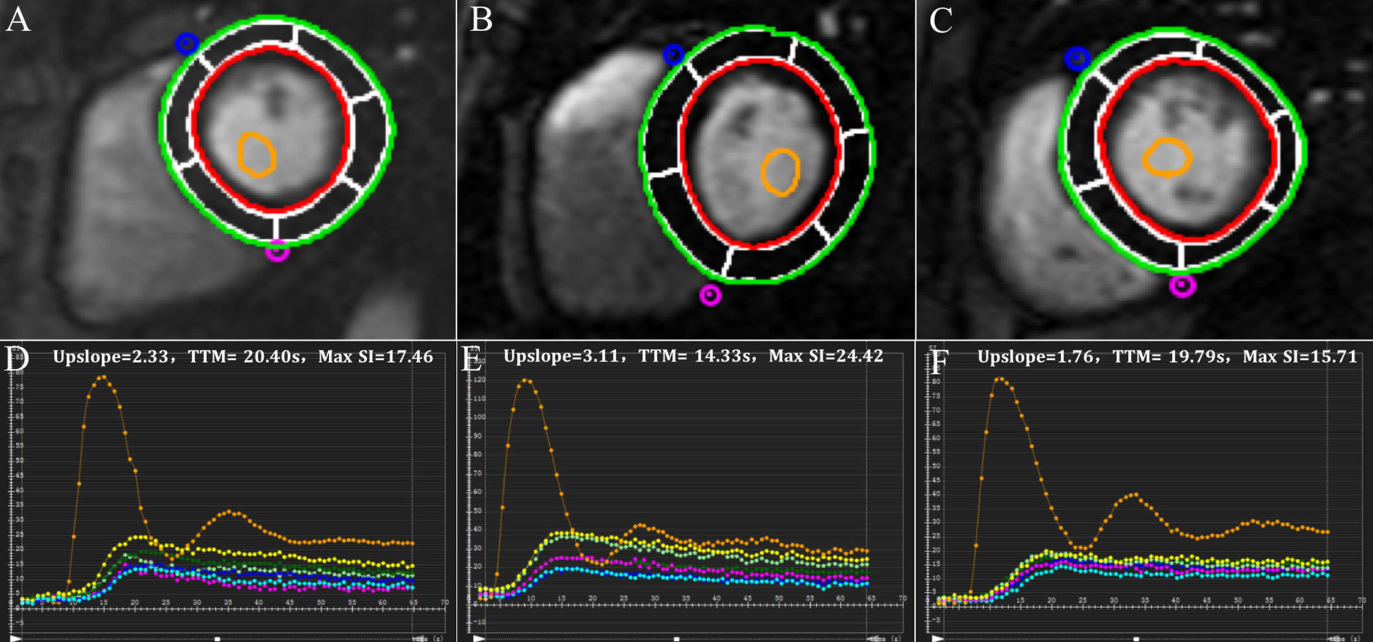 Left Ventricular Strain from Myocardial Perfusion PET Imaging