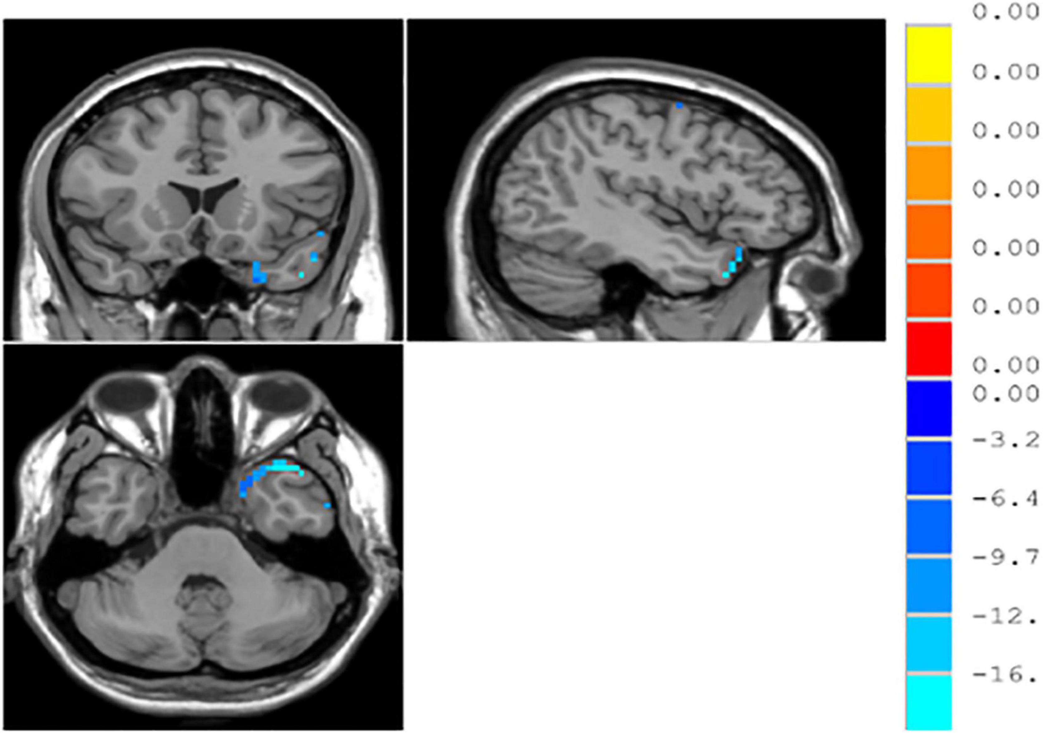 Frontiers  Neural activity in adults with major depressive disorder  differs from that in healthy individuals: A resting-state functional  magnetic resonance imaging study