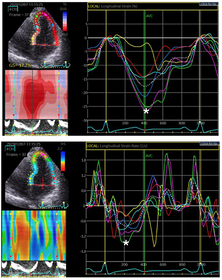 Strain, strain rate and speckle tracking: Myocardial deformation