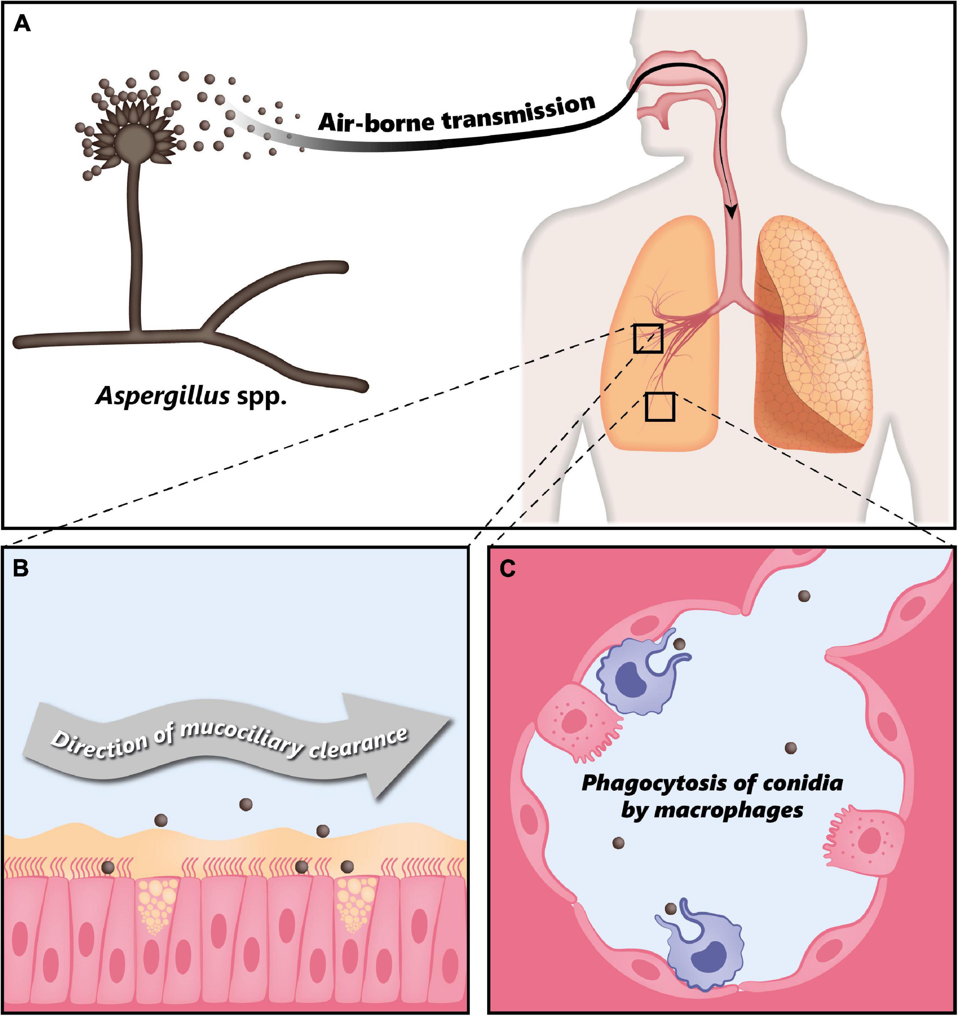 Yeast infection in on sale lungs