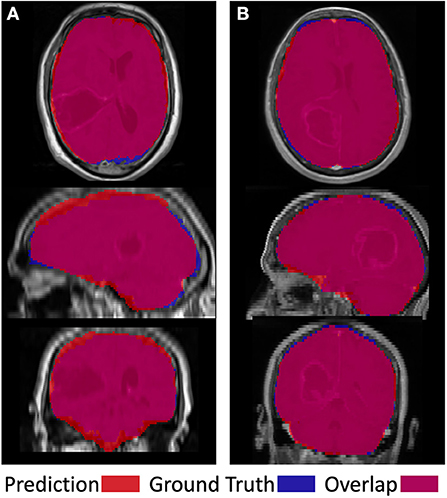 Frontiers  Automated Skull Stripping in Mouse Functional Magnetic  Resonance Imaging Analysis Using 3D U-Net