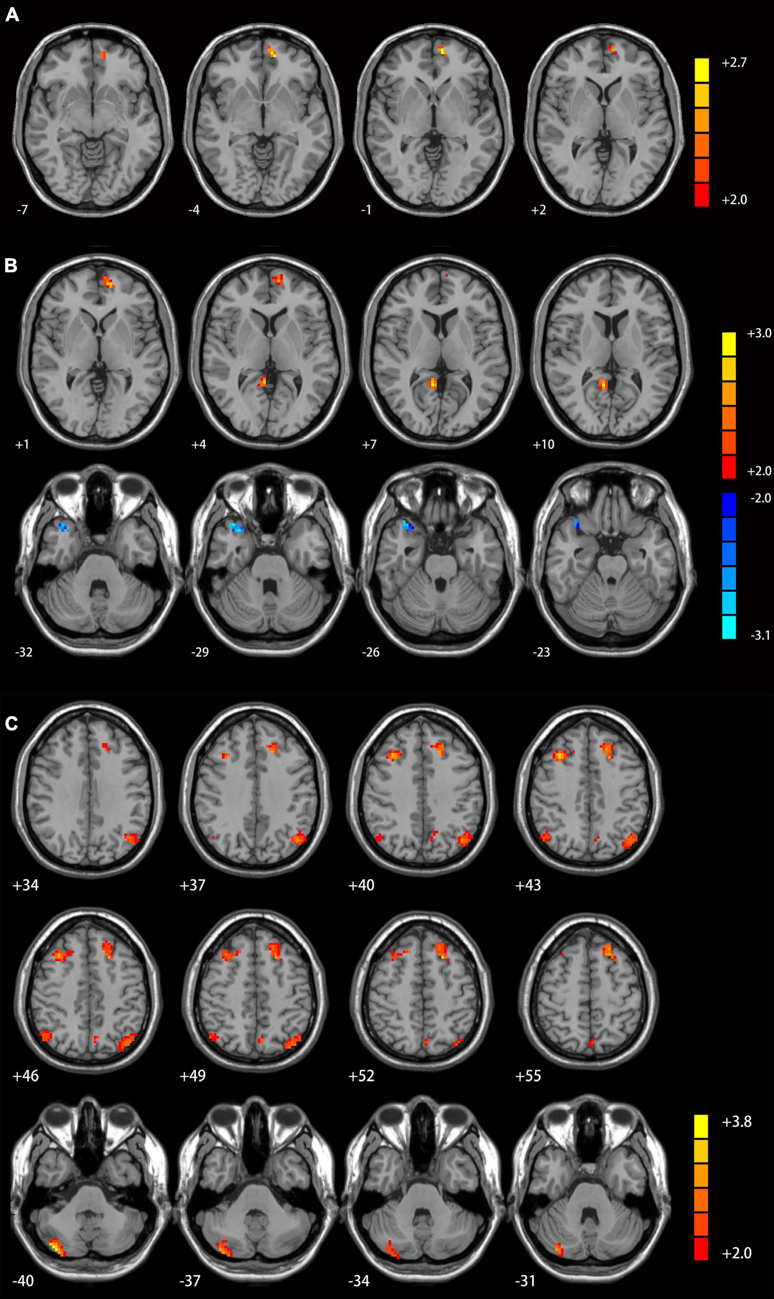 Frontiers  Neural activity in adults with major depressive disorder  differs from that in healthy individuals: A resting-state functional  magnetic resonance imaging study