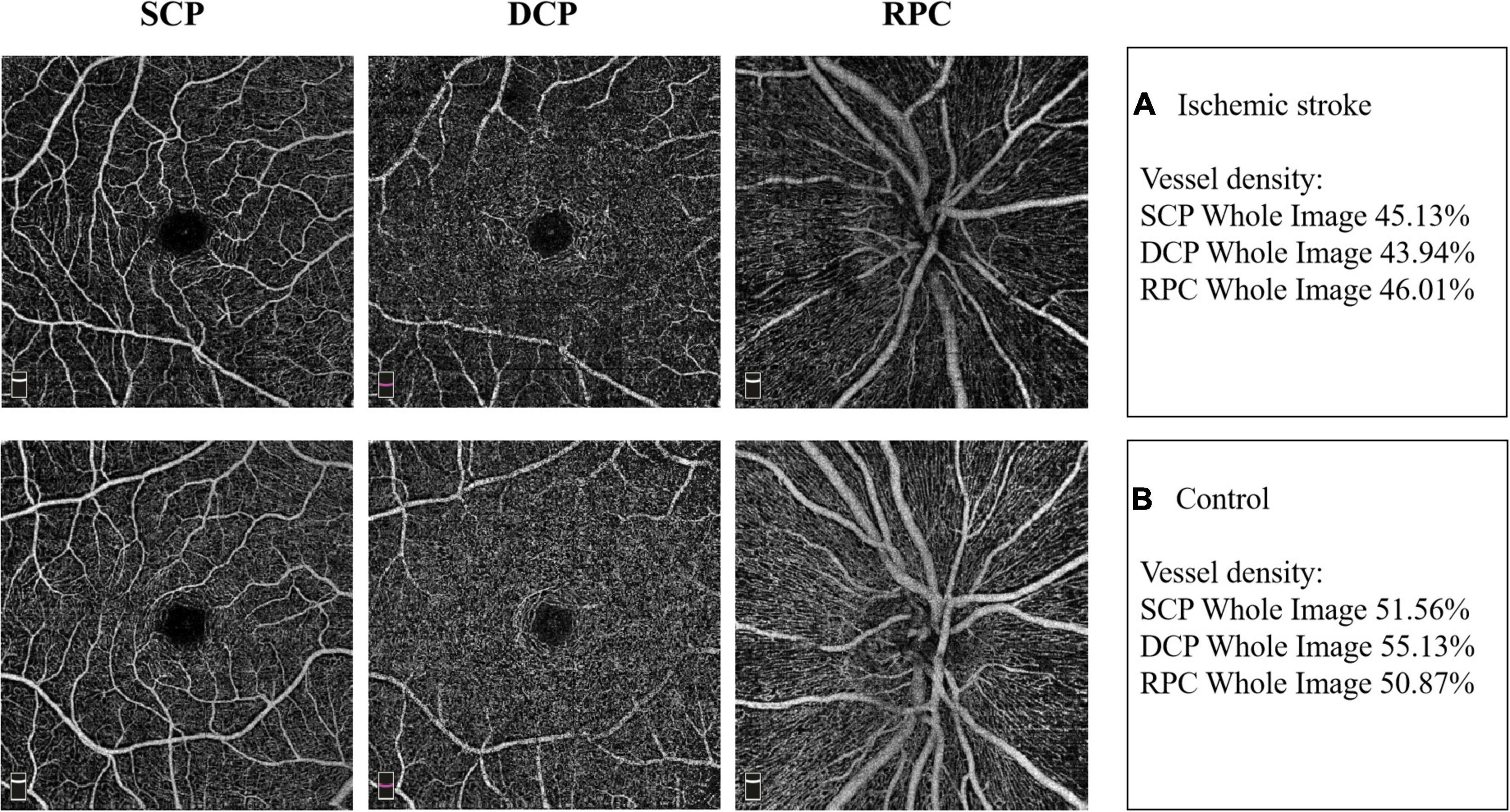 Altered ocular microvasculature in patients with systemic sclerosis and  very early disease of systemic sclerosis using optical coherence tomography  angiography