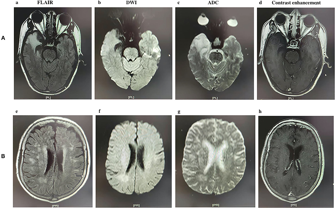 Frontiers Abnormal Brain Mri Findings In Anti N Methyl D Aspartate