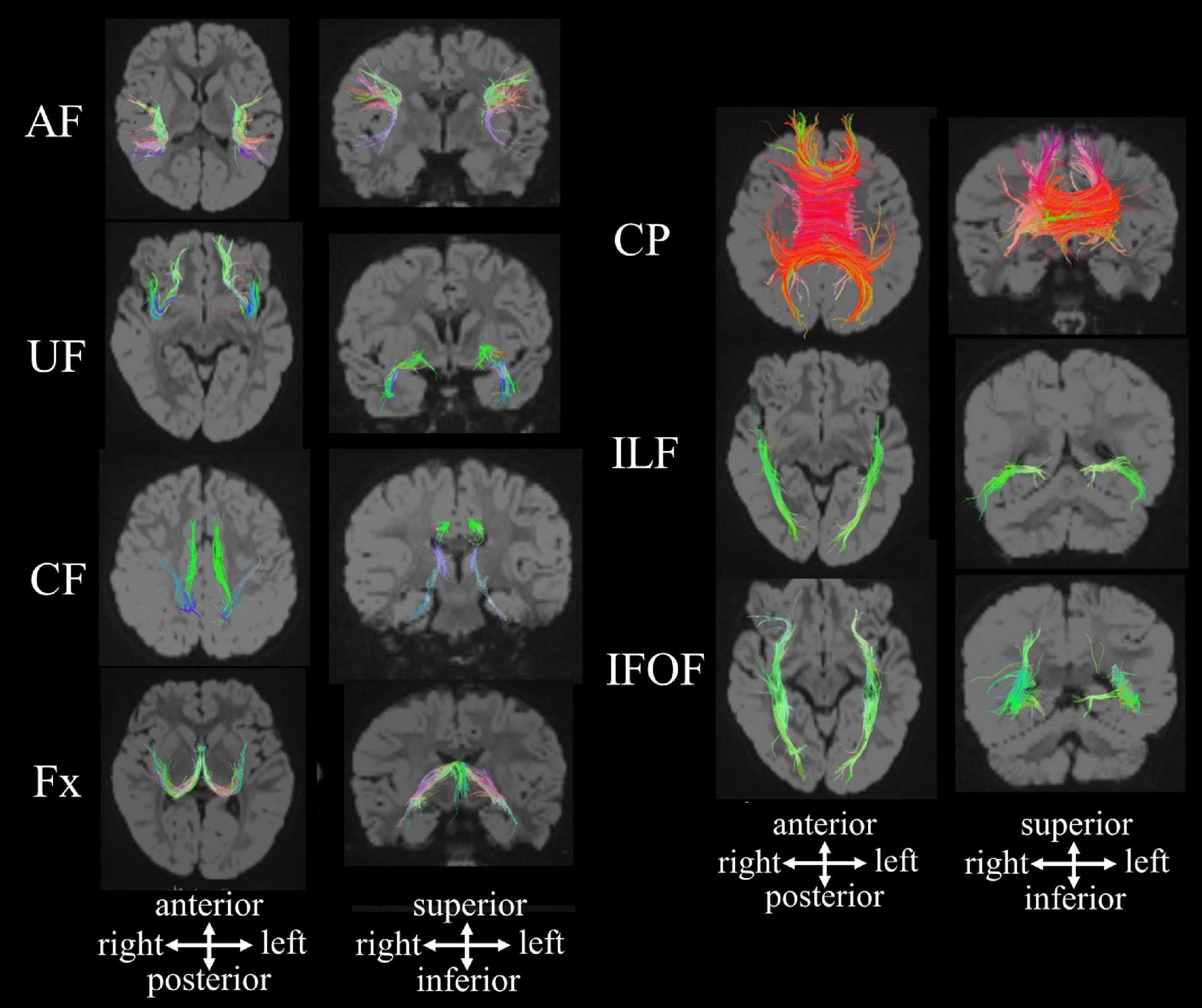 Brain MRI: What It Is, Purpose, Procedure & Results