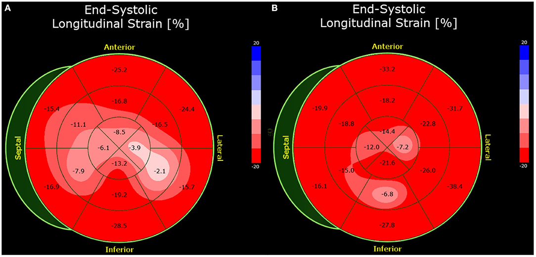 Interpreting the bull's-eye plot in speckle tracking echocardiogr