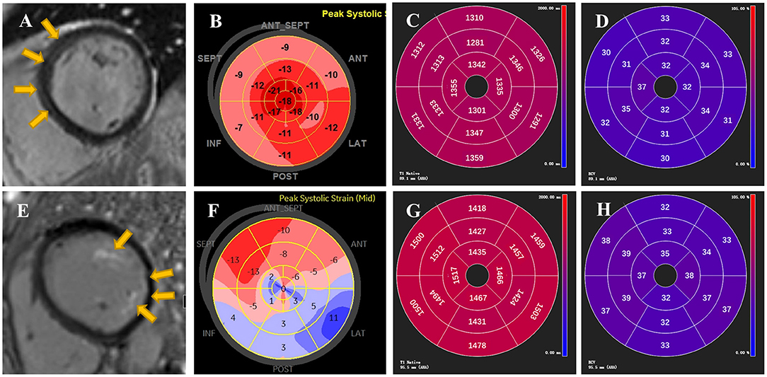 Frontiers  Echocardiographic Global Longitudinal Strain Is