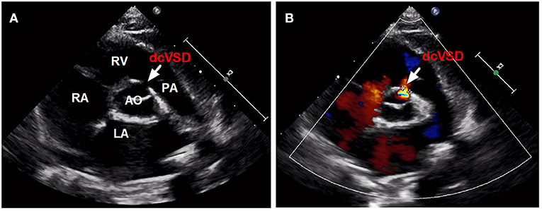 Frontiers | Transfemoral Occlusion of Doubly Committed Subarterial ...