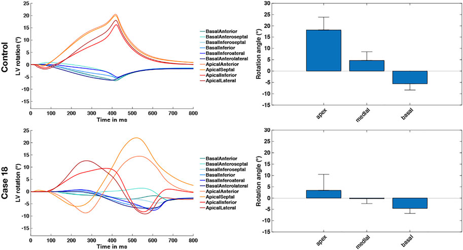 Frontiers  Dyssynchronous Left Ventricular Activation is Insufficient for  the Breakdown of Wringing Rotation