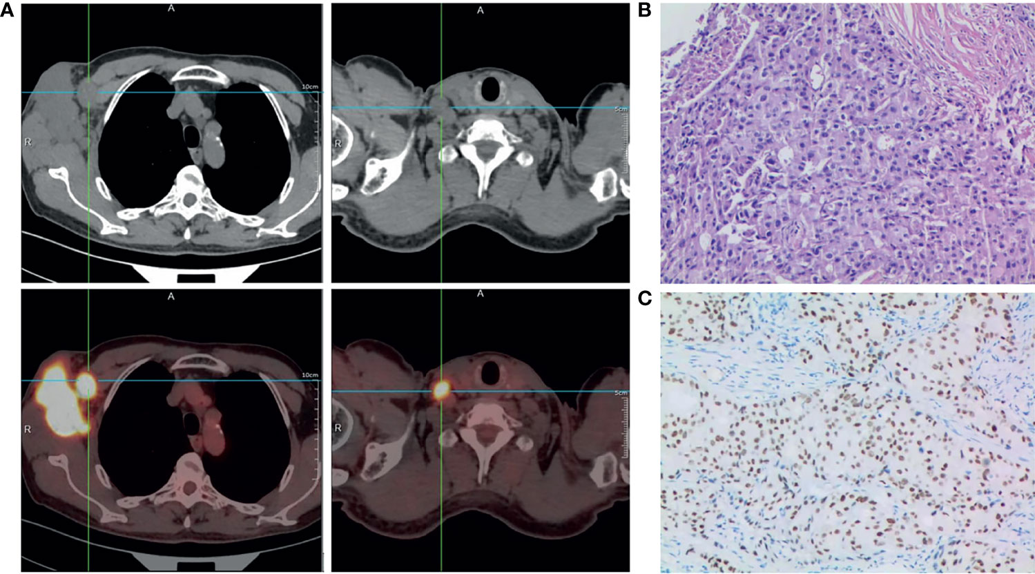 Efficacy of lapatinib monotherapy on occult breast cancer presenting with  cutaneous metastases: A case report