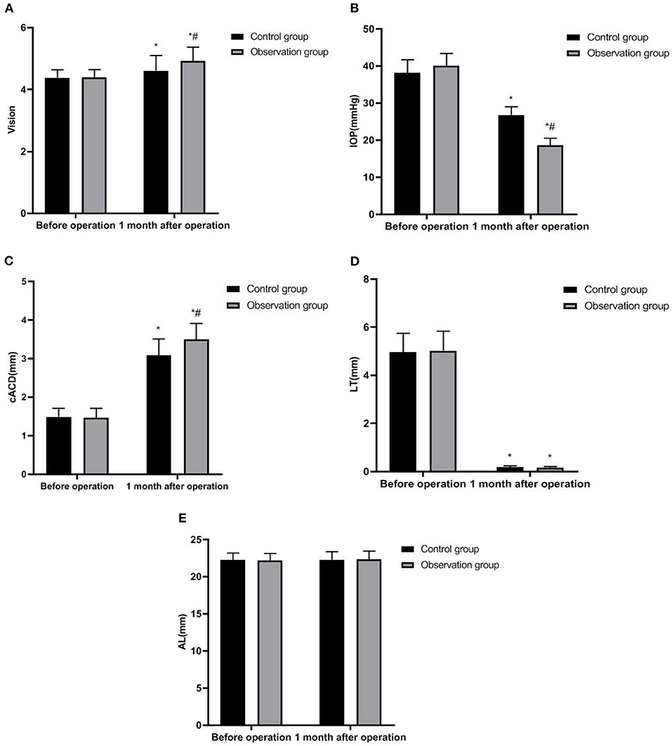 Frontiers Analysis Of The Effect Of Phacoemulsification And 