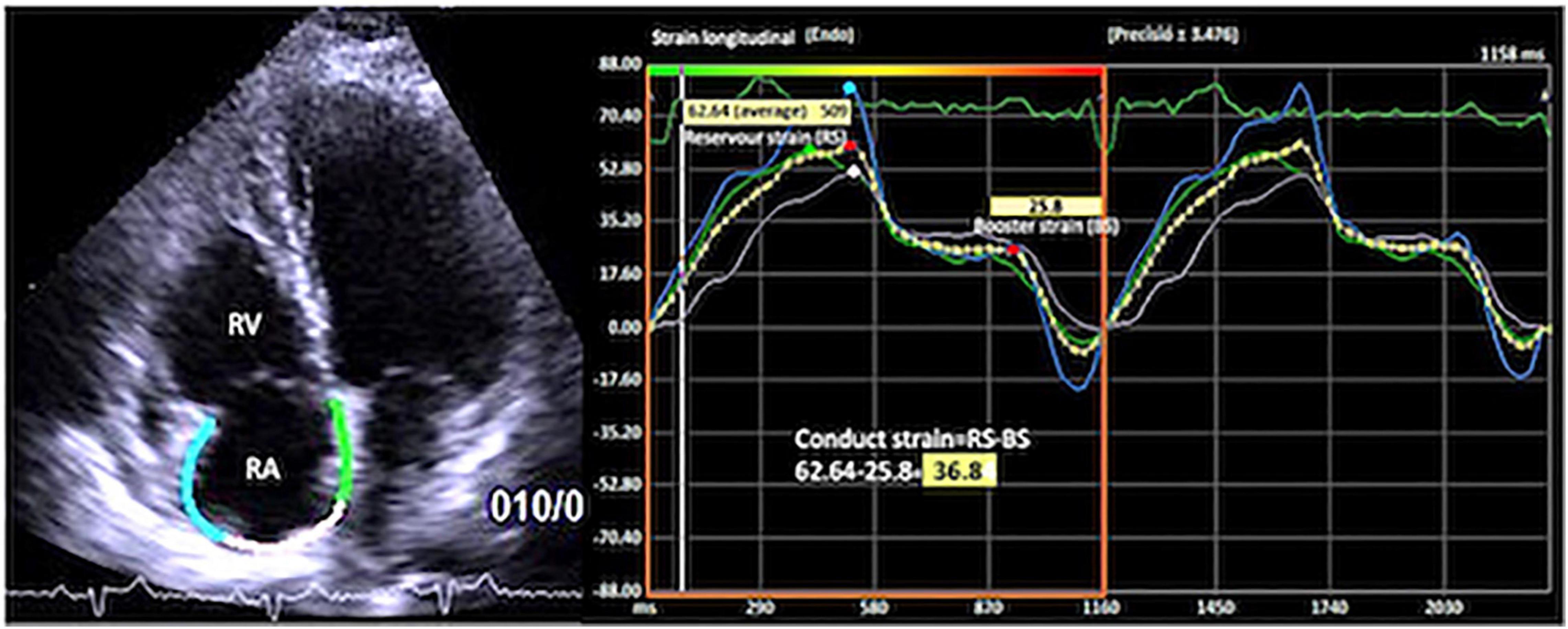 Global Longitudinal Strain Echo Offers Early Detection of