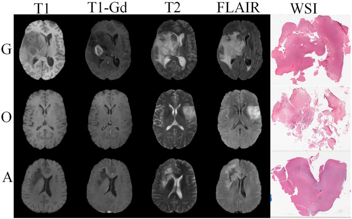 Ynkelig chef acceptere Frontiers | Combining Radiology and Pathology for Automatic Glioma  Classification
