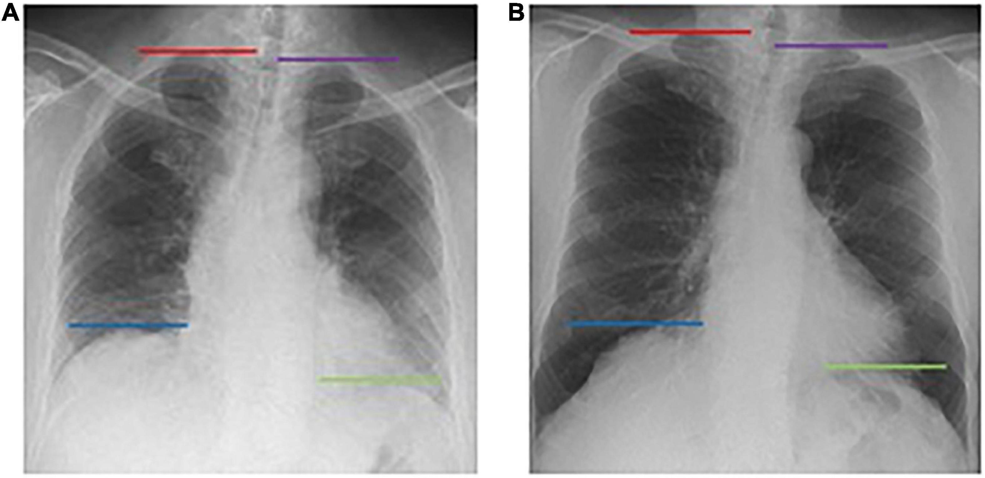 Frontiers Quantitative evaluation of diaphragmatic motion during