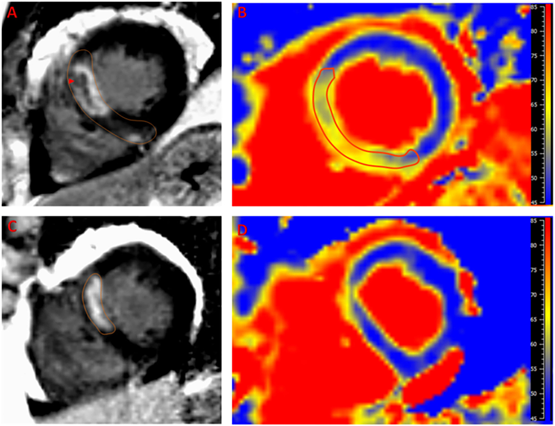 Left ventricular global strains by linear measurements in three