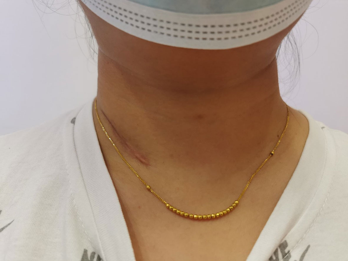 Statement necklaces to hide thyroid scar