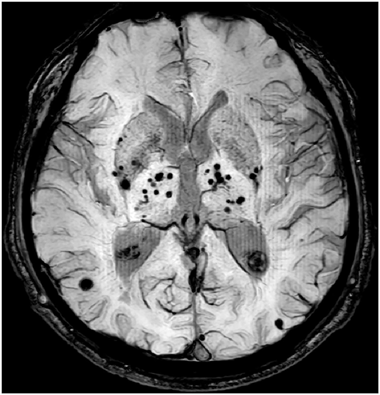 Frontiers Lobar Cerebral Microbleeds Are Associated With Cognitive