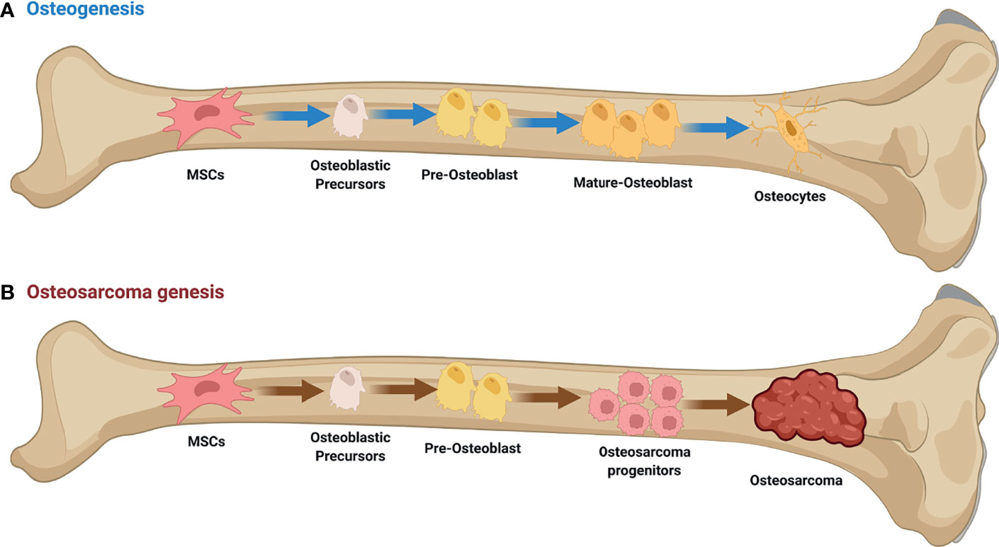 Osteosarcoma