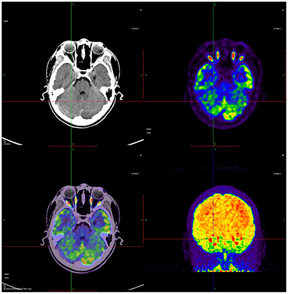 Brain PET scan