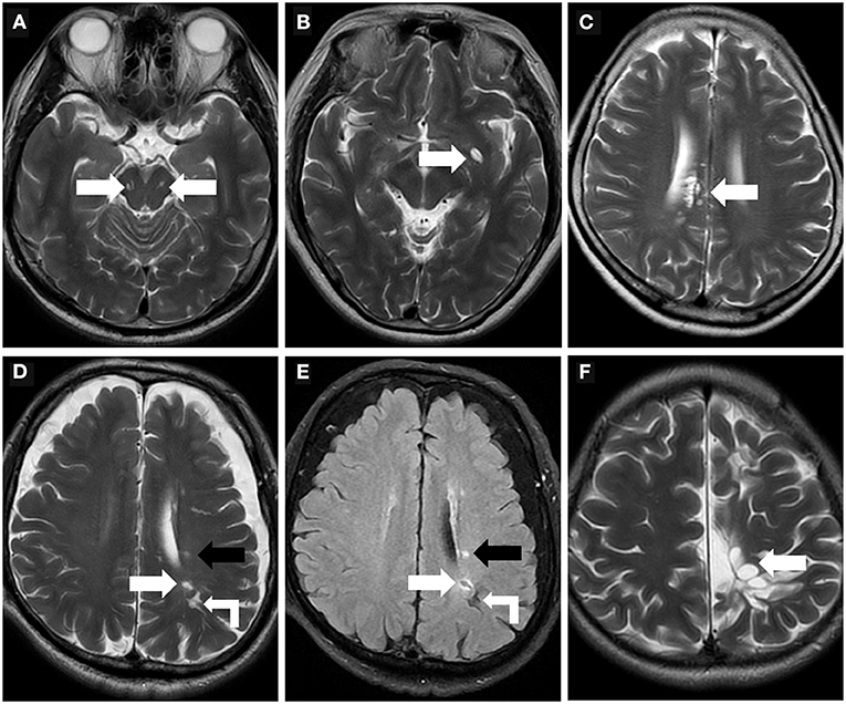 Frontiers | Perivascular Spaces, Glymphatic System and MR