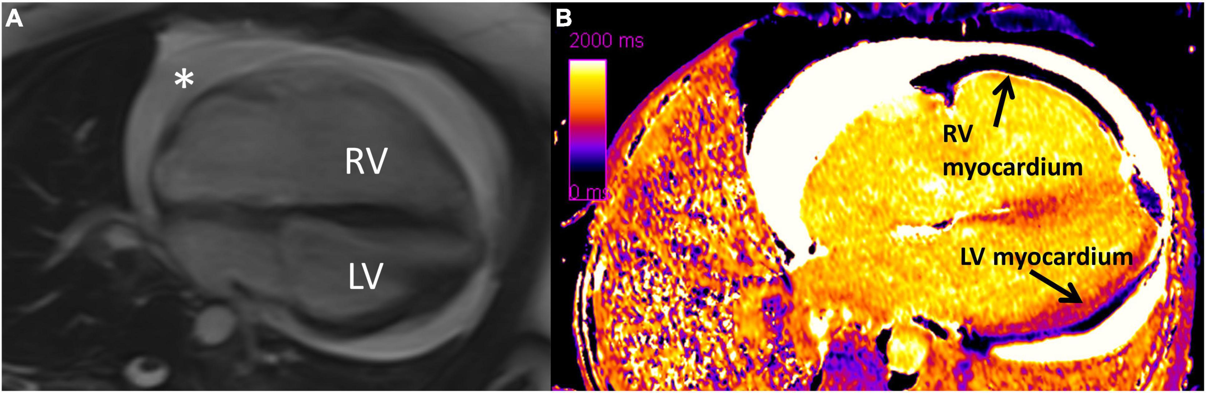 Progression of Left Ventricular Myocardial Dysfunction in Systemic  Sclerosis: A Speckle-tracking Strain Echocardiography Study