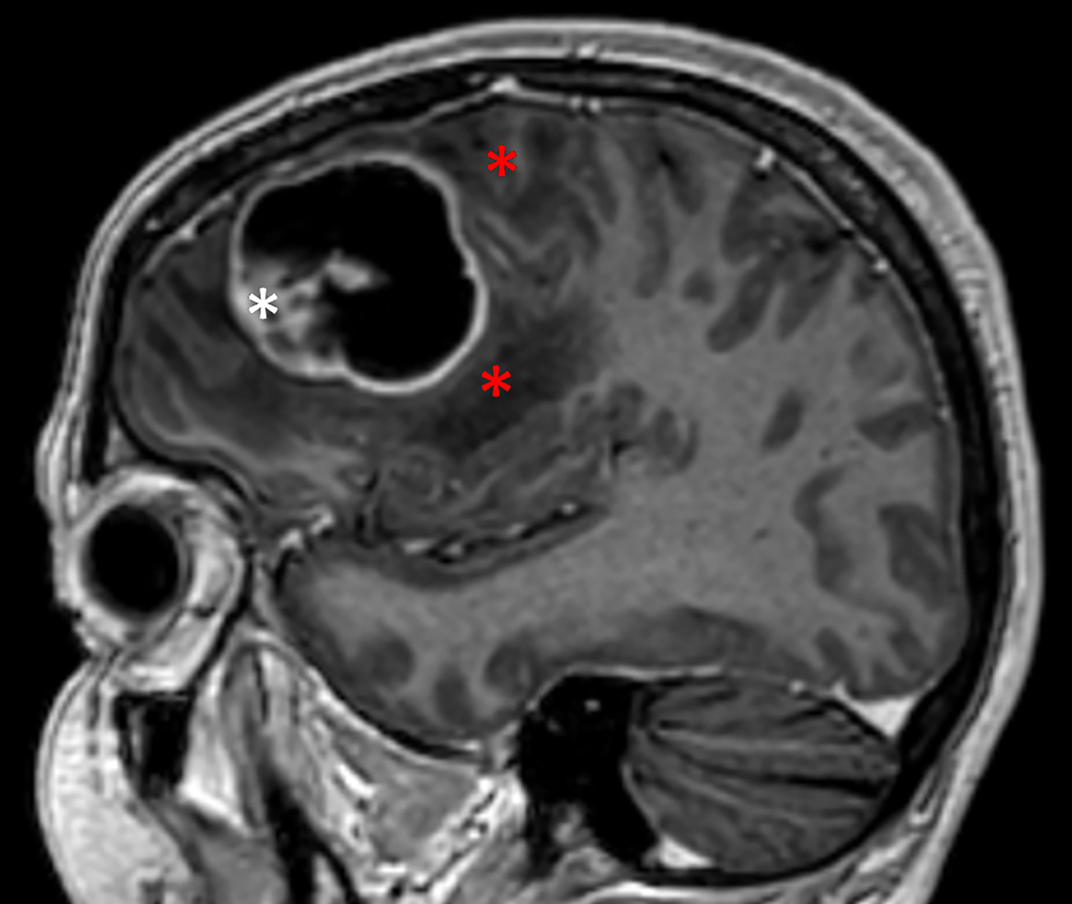 Frontiers | Pro-inflammatory cytokines in cystic glioblastoma: A quantitative study with a comparison with bacterial abscesses. With an MRI investigation of and destruction of the brain tissue surrounding a glioblastoma
