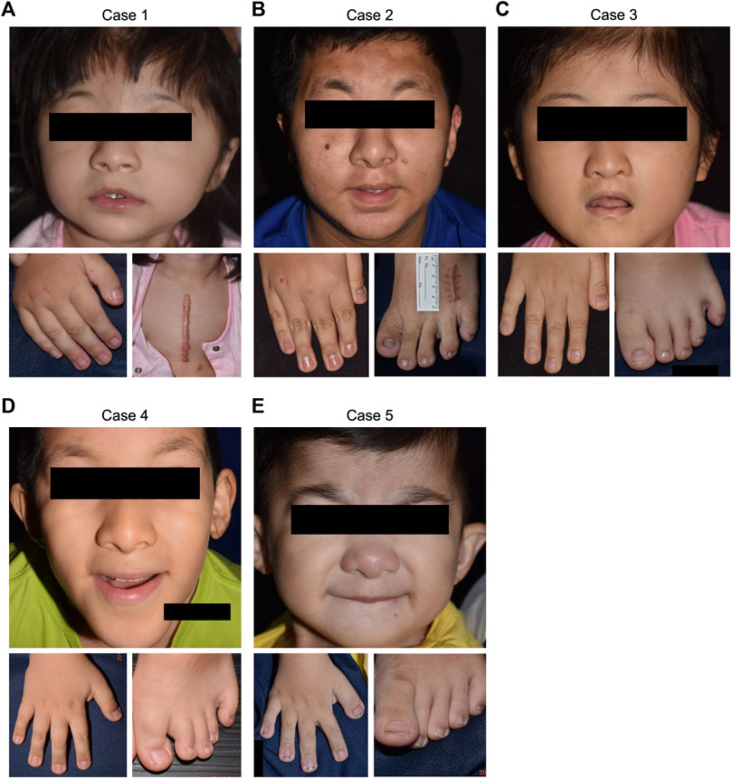 Rubinstein-Taybi Syndrome: A case report