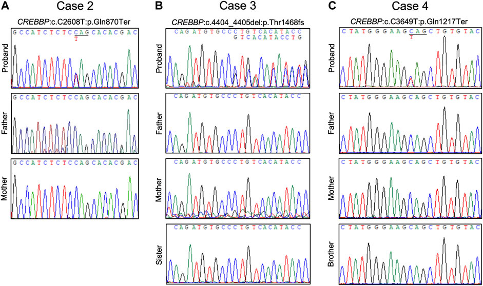 Müllerian Agenesis in a patient with Rubinstein-Taybi Syndrome: A Case  Series and Review of the Overlapping Developmental Biologic Pathways -  Journal of Pediatric and Adolescent Gynecology