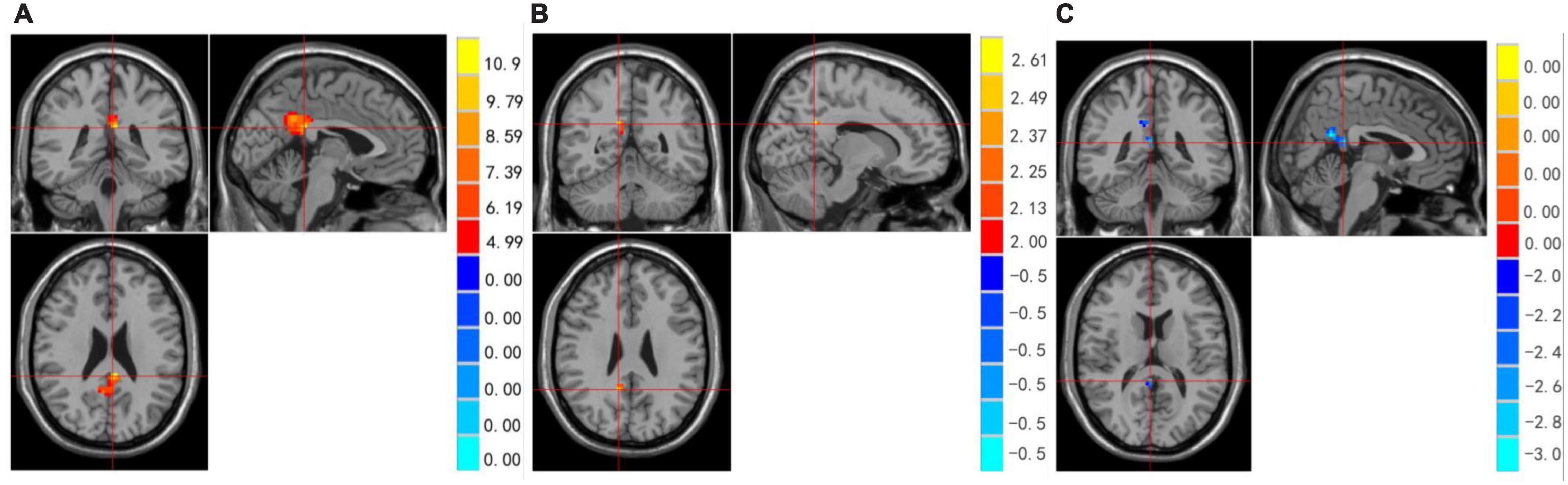 Frontiers  Neural activity in adults with major depressive disorder  differs from that in healthy individuals: A resting-state functional  magnetic resonance imaging study