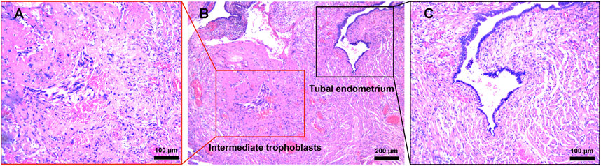 Frontiers  Concurrent Ovarian and Tubal Ectopic Pregnancy After