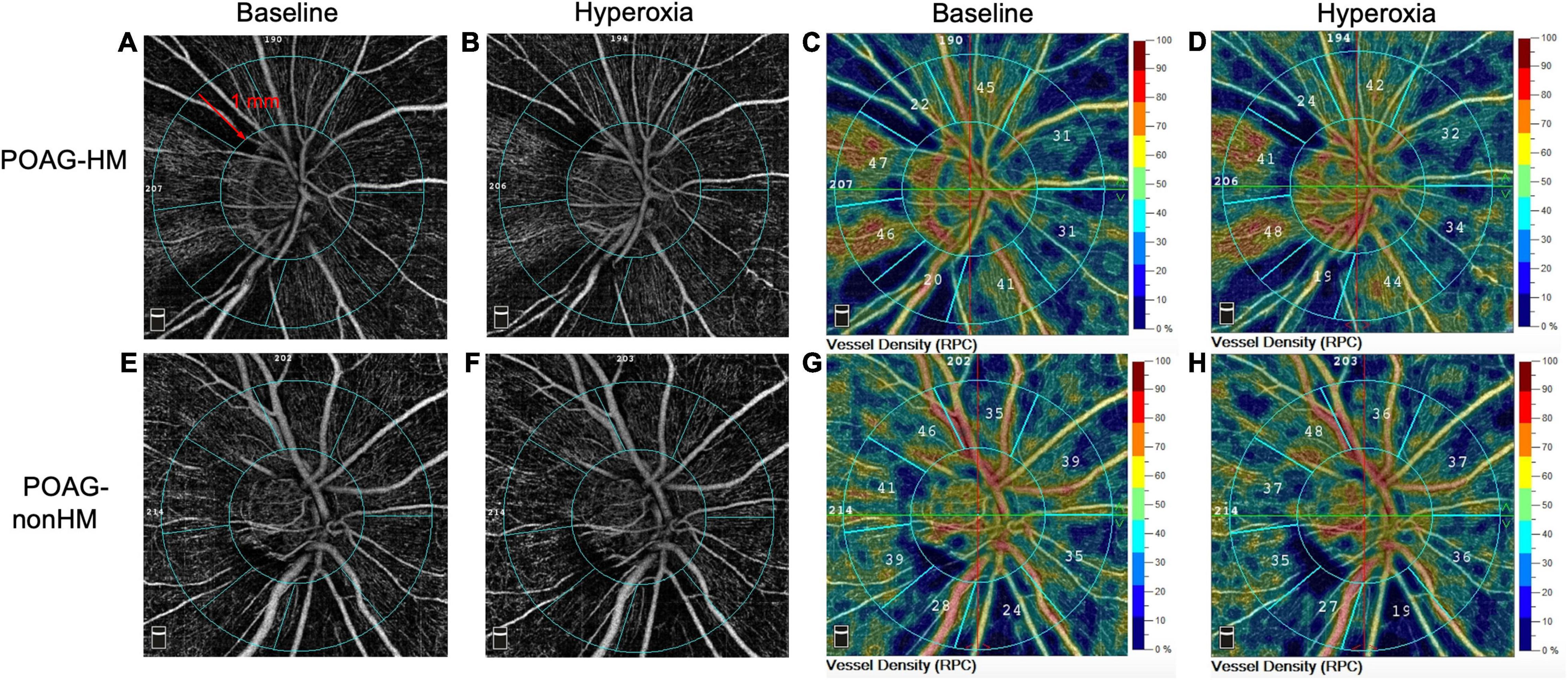 Retinal vascular assessment in psoriatic patients with and without  metabolic syndrome using optical coherence tomography angiography