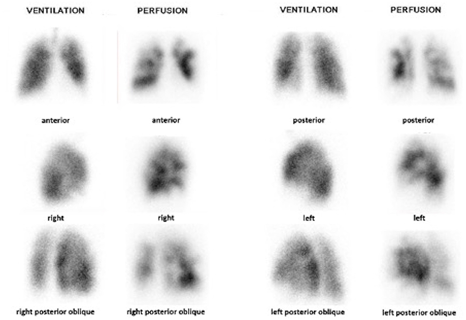 Frontiers | Lung Ventilation/Perfusion Scintigraphy for the of Chronic Pulmonary Hypertension (CTEPH): Which Criteria to