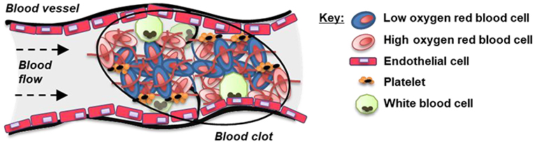 Figure 2 - Sometimes blood can clot inside a blood vessel.