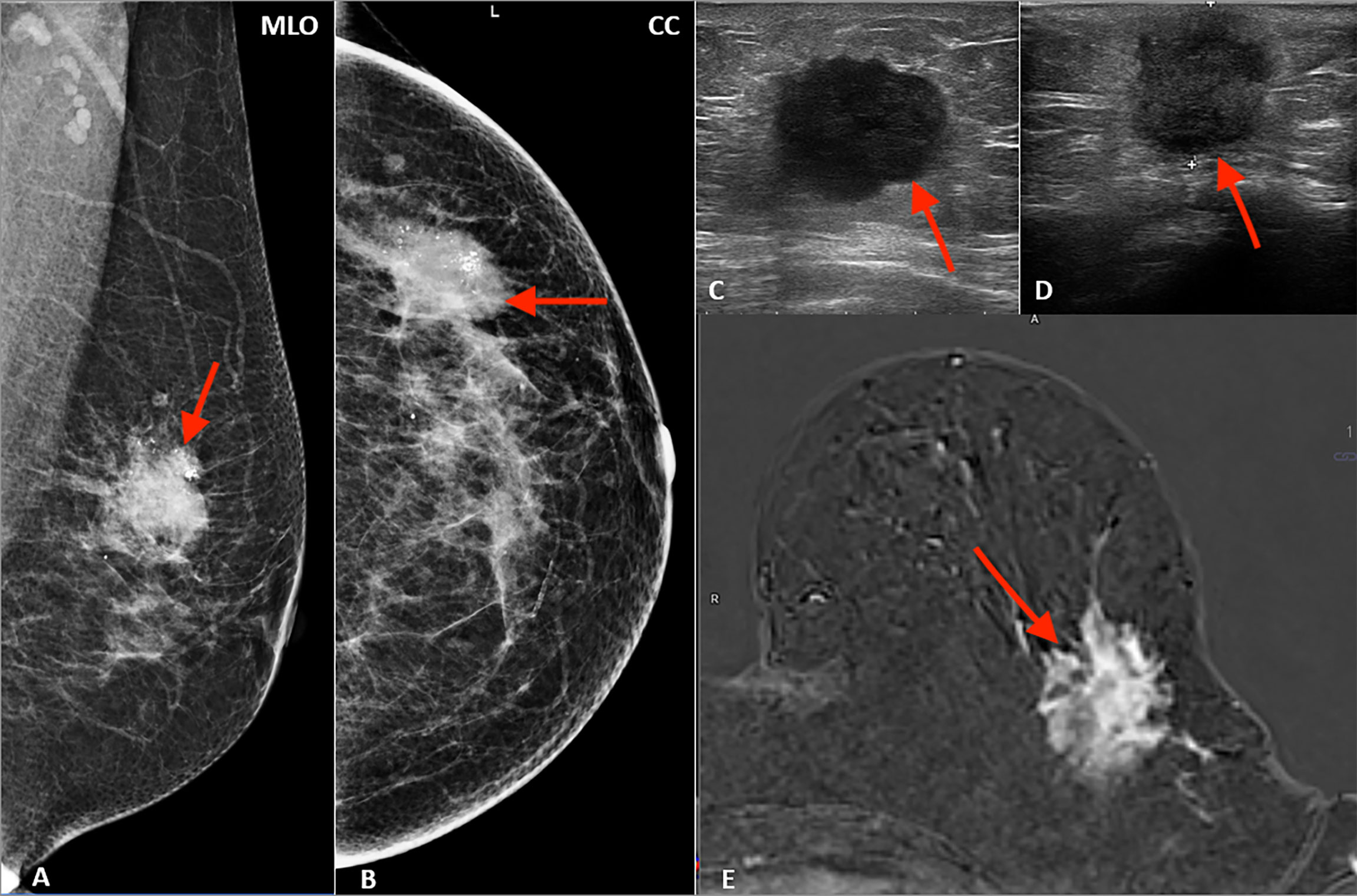 Breast Cancer Mammogram