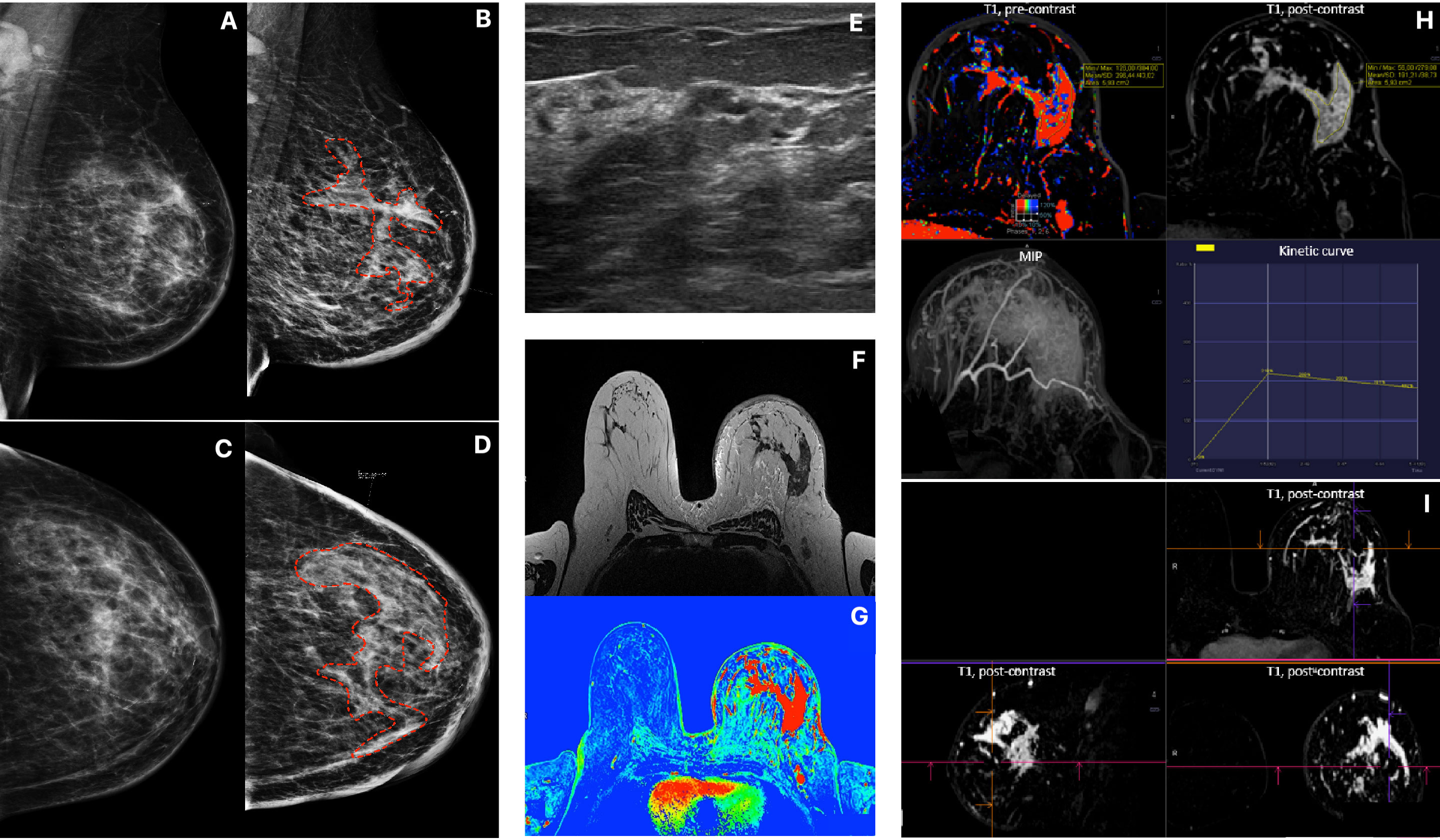 Breast Anatomy - Radiology