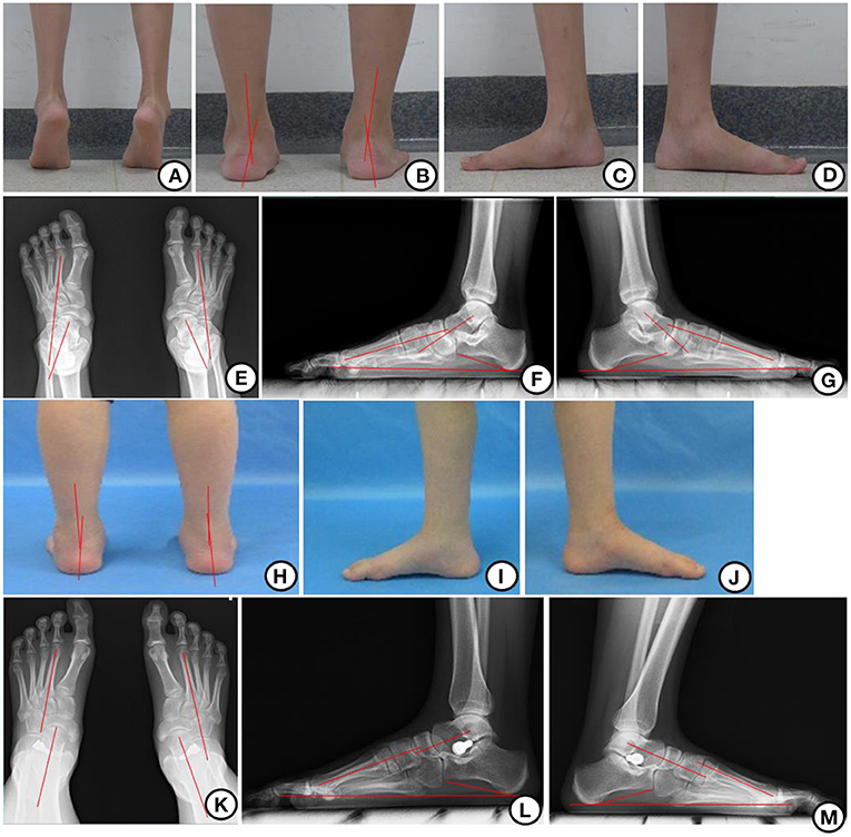 Top more than 116 heel pain after gastroc recession best - esthdonghoadian