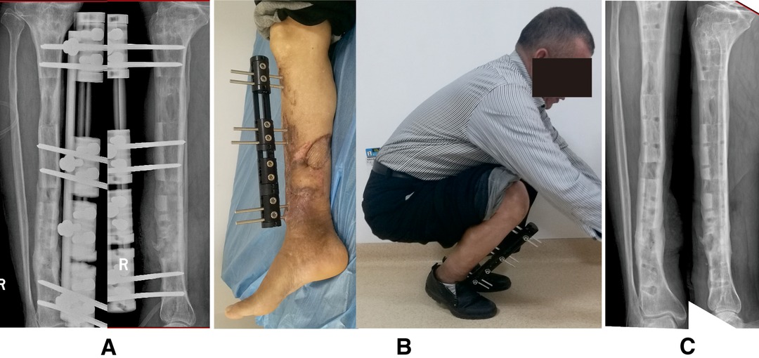 Management of post-traumatic bone defects of the tibia using vascularised fibular graft combined with Ilizarov external fixator - ScienceDirect
